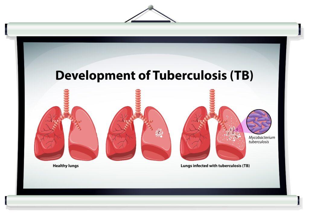 Tuberculosis Transmission How It Spreads and Prevention